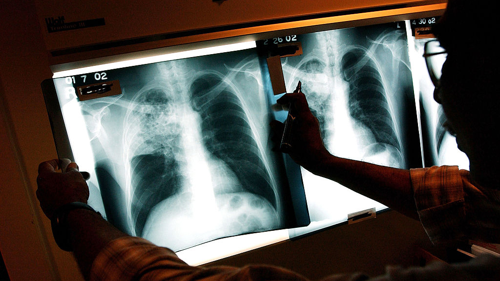2 active tuberculosis cases traced to San Francisco strip club — KTVU FOX 2 Bay Area, Woodside Health news